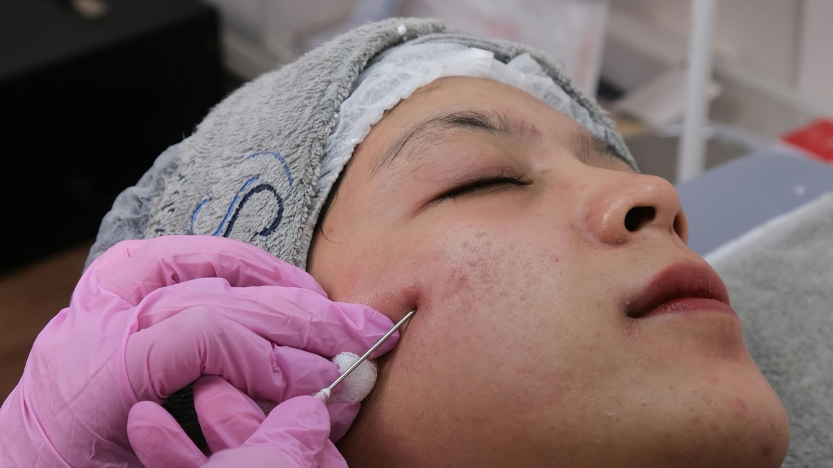 5 Remedies That Effectively Treat Hyperpigmentation
